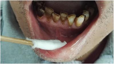 Numb Chin Syndrome Leading to a Diagnosis of Salivary Ductal Adenocarcinoma: A Case Report and Review of the Literature